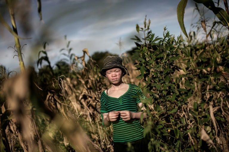 Albinos are often targeted in brutal attacks in Malawi - one of the world's poorest countries - because they have white skin due to a hereditary lack of pigmentation (AFP Photo/GIANLUIGI GUERCIA)